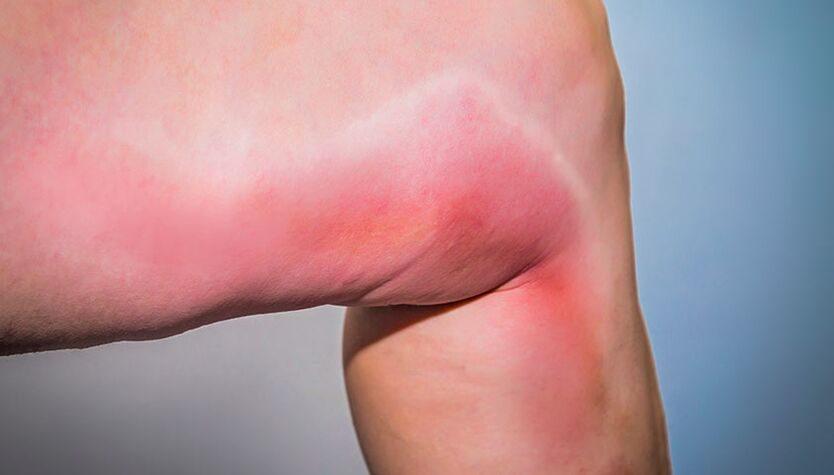 La thrombophlébite est une complication des varices.