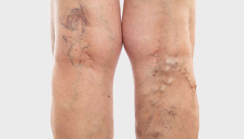 Les varices affectent différentes veines.