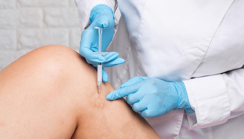procédure de sclérothérapie pour les varices