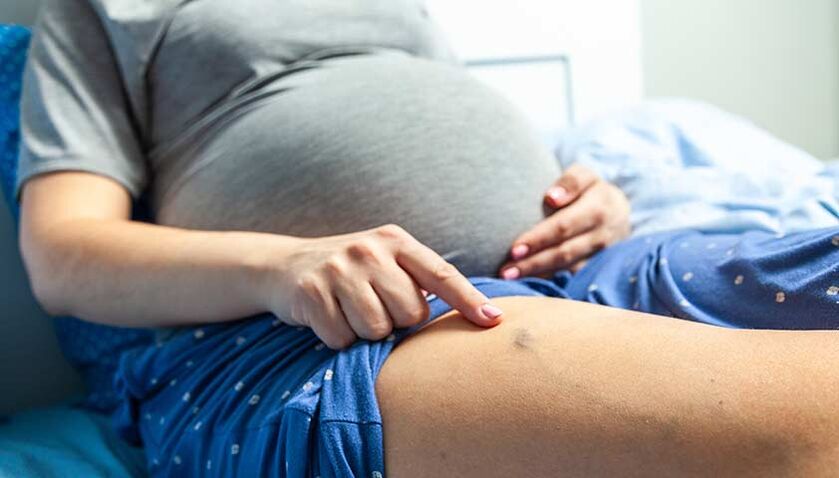 varices chez la femme enceinte