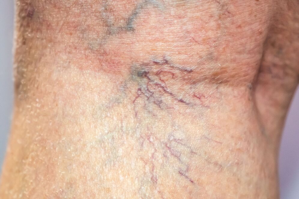 varices dans le corps