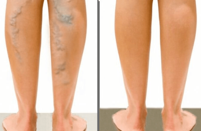 Varices avant et après la chirurgie