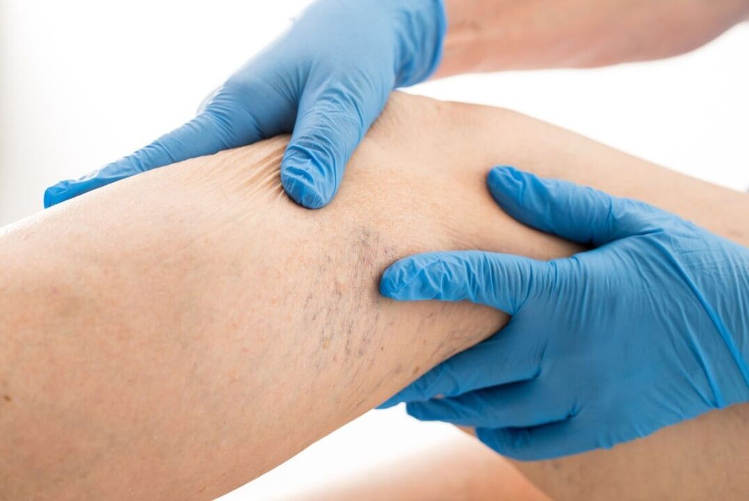Maladie clinique des cartes varices
