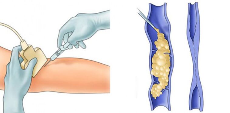 Traitement des varices