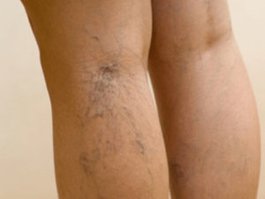 La deuxième étape des varices