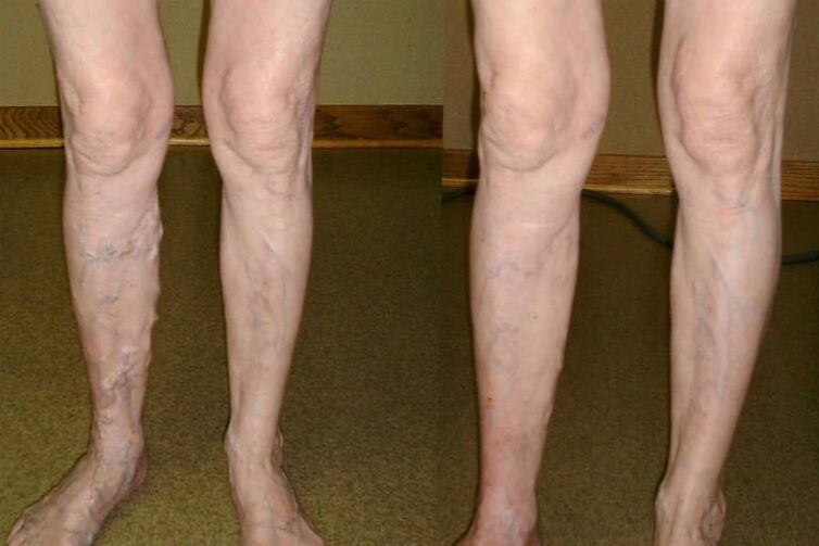 varices chez les hommes