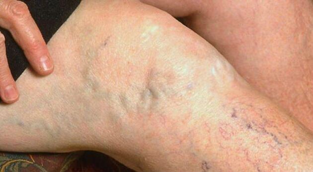 Symptômes visibles de varices dans les jambes.