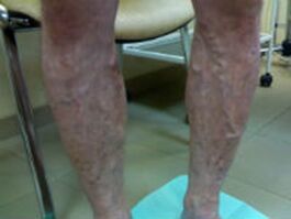 Varices dans les jambes.