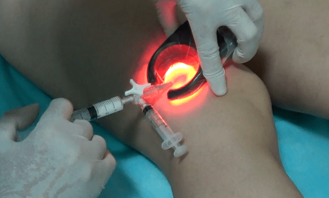 La sclérothérapie est une méthode efficace pour traiter les varices des jambes.