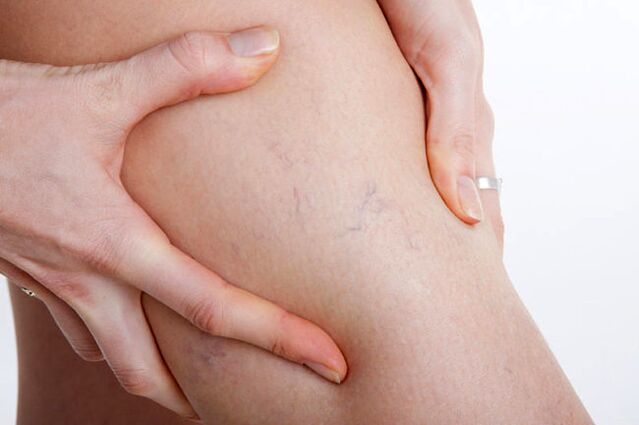Les premières apparitions de varices dans la jambe.