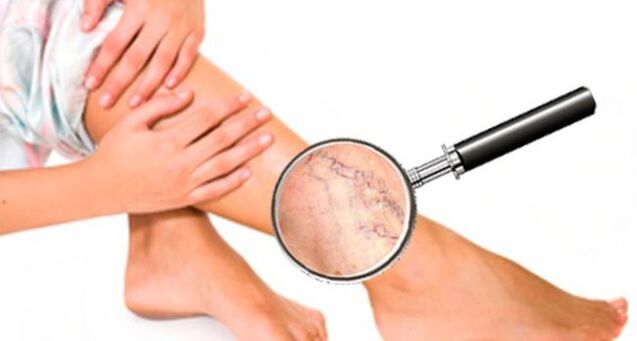 Varices dans les jambes.